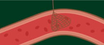 transcatheter aortic replacement surgery